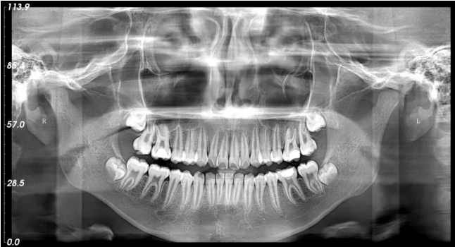 ▲美亚口腔CBCT—全景