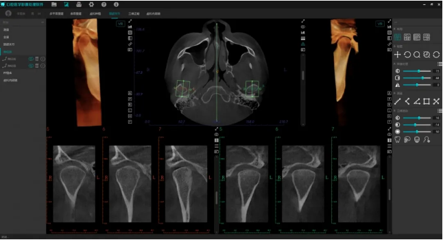 ▲美亚口腔CBCT—自动TMJ
