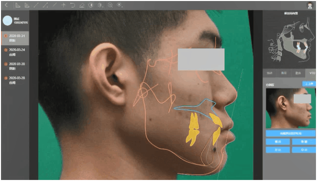 ▲VTO可视化矫正模拟功能，直观地模拟术后效果