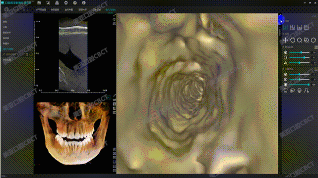▲正常牙齿内窥镜功能重建下颌神经管壁三维结构，发现神经管壁内部通畅，无牙根深入