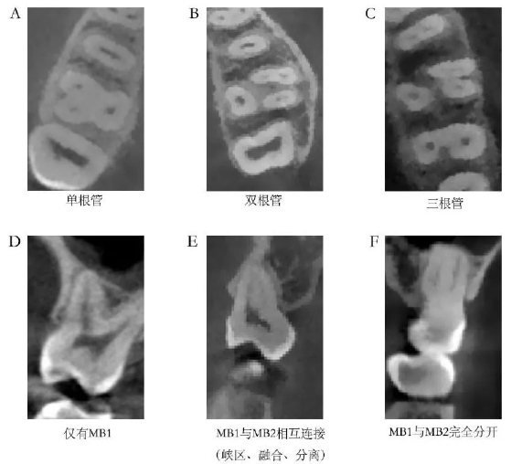 ▲近颊根管系统的形态（以上图片来源于网络）