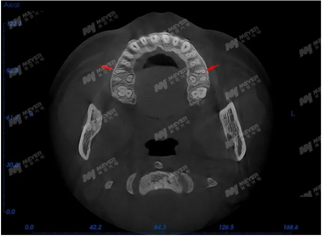 ▲美亚口腔CBCT准确显示MB2位置